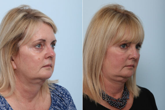 Juvederm Voluma XC before and after photos in Houston, TX, Patient 42610