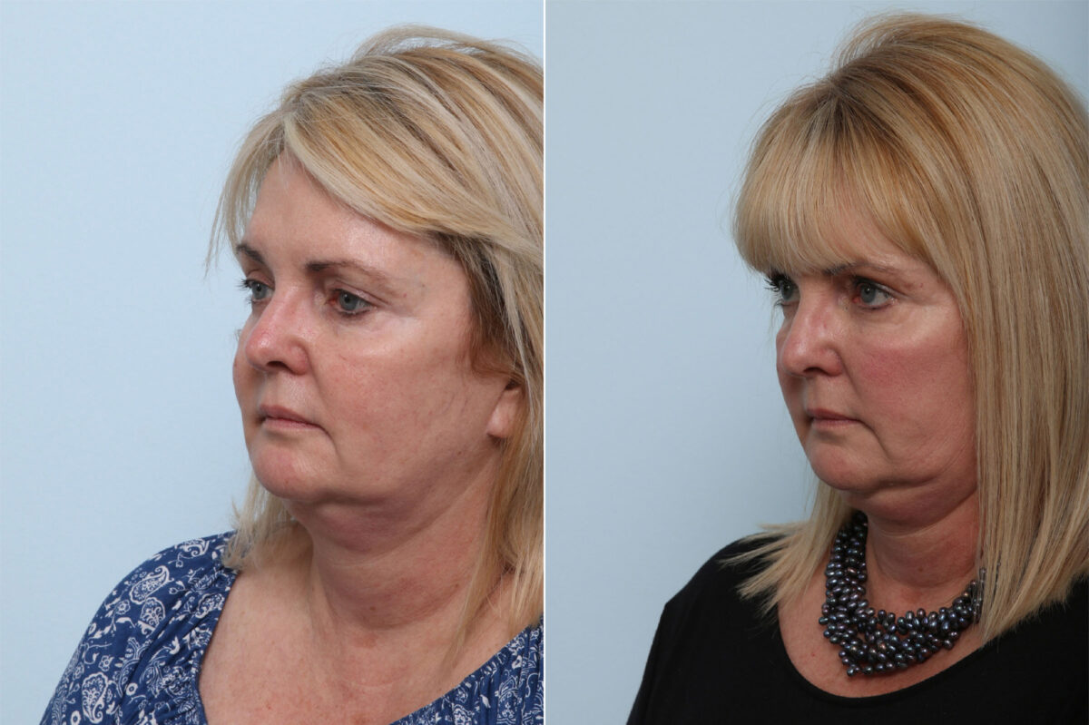 Juvederm Voluma XC before and after photos in Houston, TX, Patient 42610