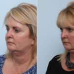 Juvederm Voluma XC before and after photos in Houston, TX, Patient 42610