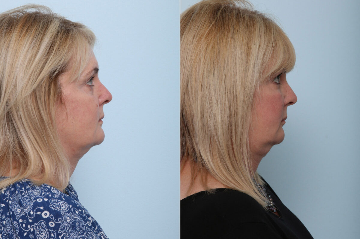 Juvederm Voluma XC before and after photos in Houston, TX, Patient 42610