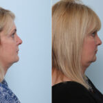 Juvederm Voluma XC before and after photos in Houston, TX, Patient 42610