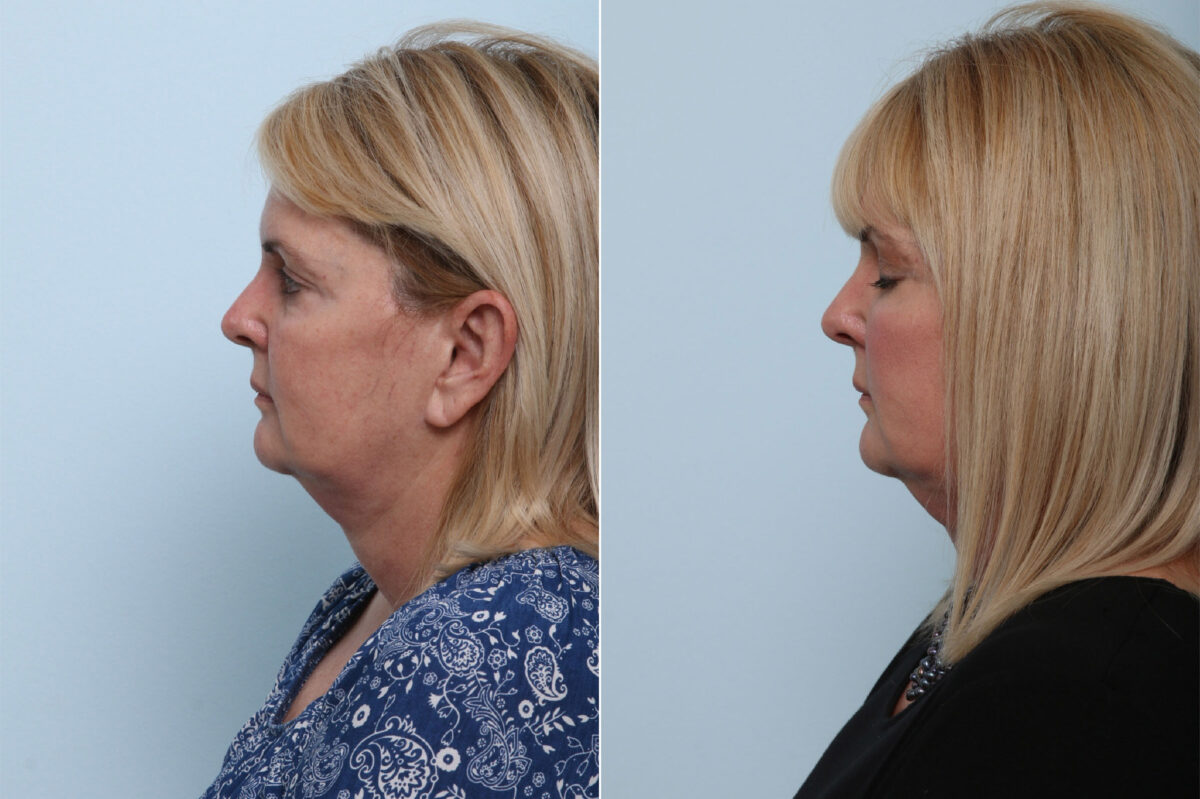 Juvederm Voluma XC before and after photos in Houston, TX, Patient 42610