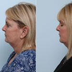 Juvederm Voluma XC before and after photos in Houston, TX, Patient 42610