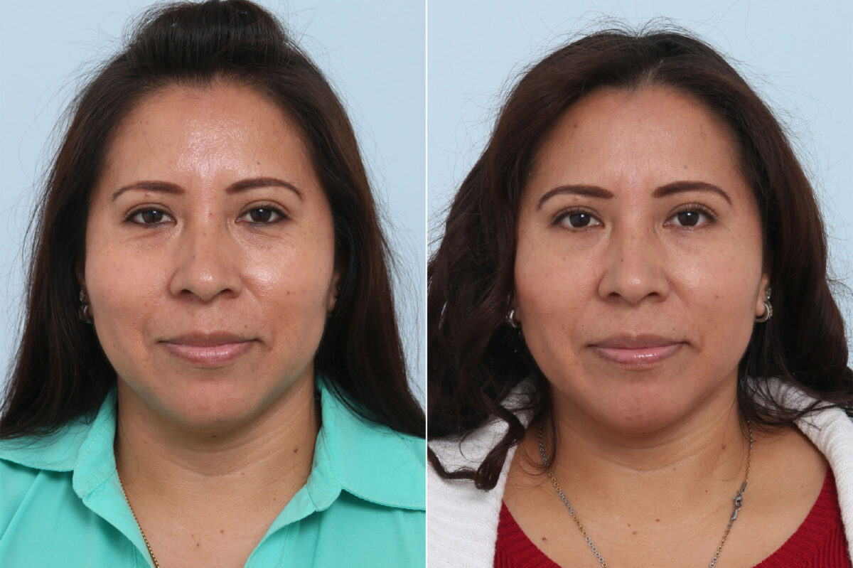 Juvederm Voluma XC before and after photos in Houston, TX, Patient 42631