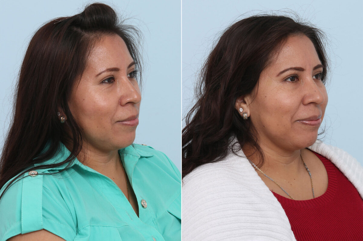 Juvederm Voluma XC before and after photos in Houston, TX, Patient 42631