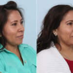 Juvederm Voluma XC before and after photos in Houston, TX, Patient 42631