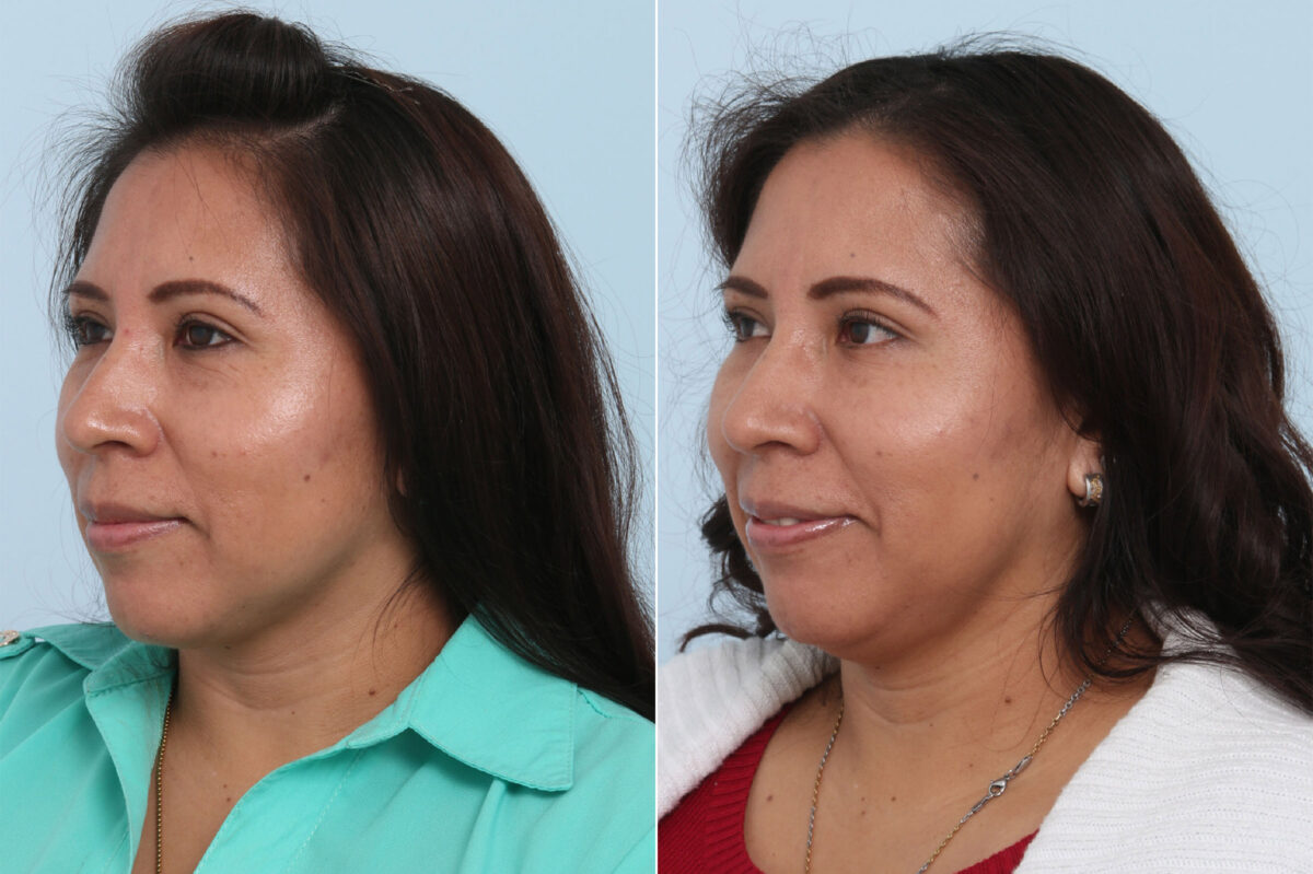 Juvederm Voluma XC before and after photos in Houston, TX, Patient 42631