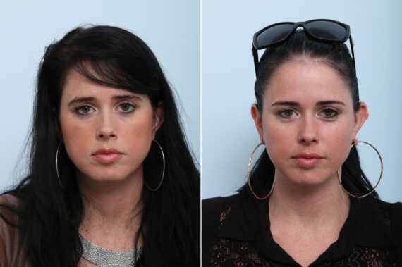 Juvederm Voluma XC before and after photos in Houston, TX, Patient 42644