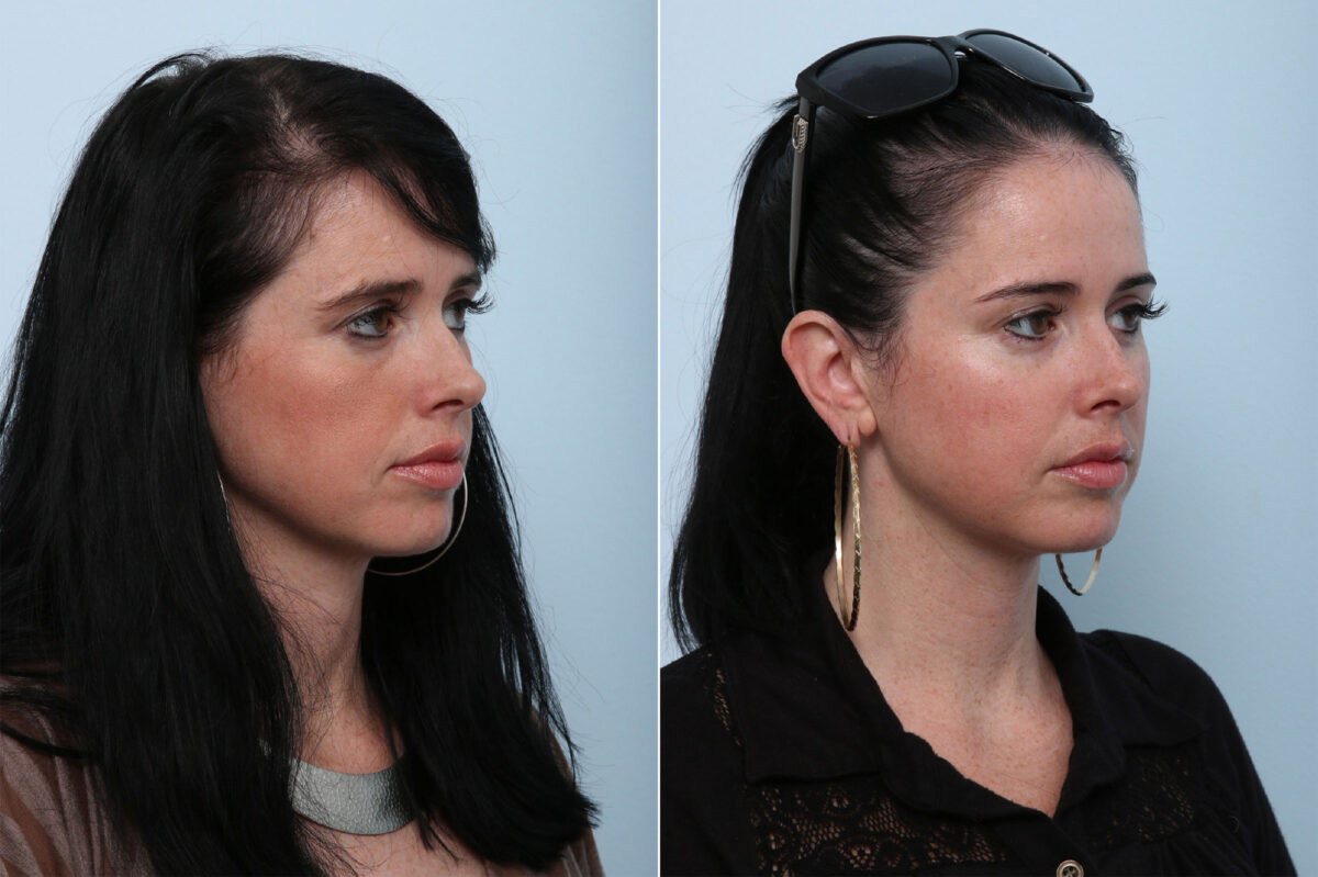 Juvederm Voluma XC before and after photos in Houston, TX, Patient 42644
