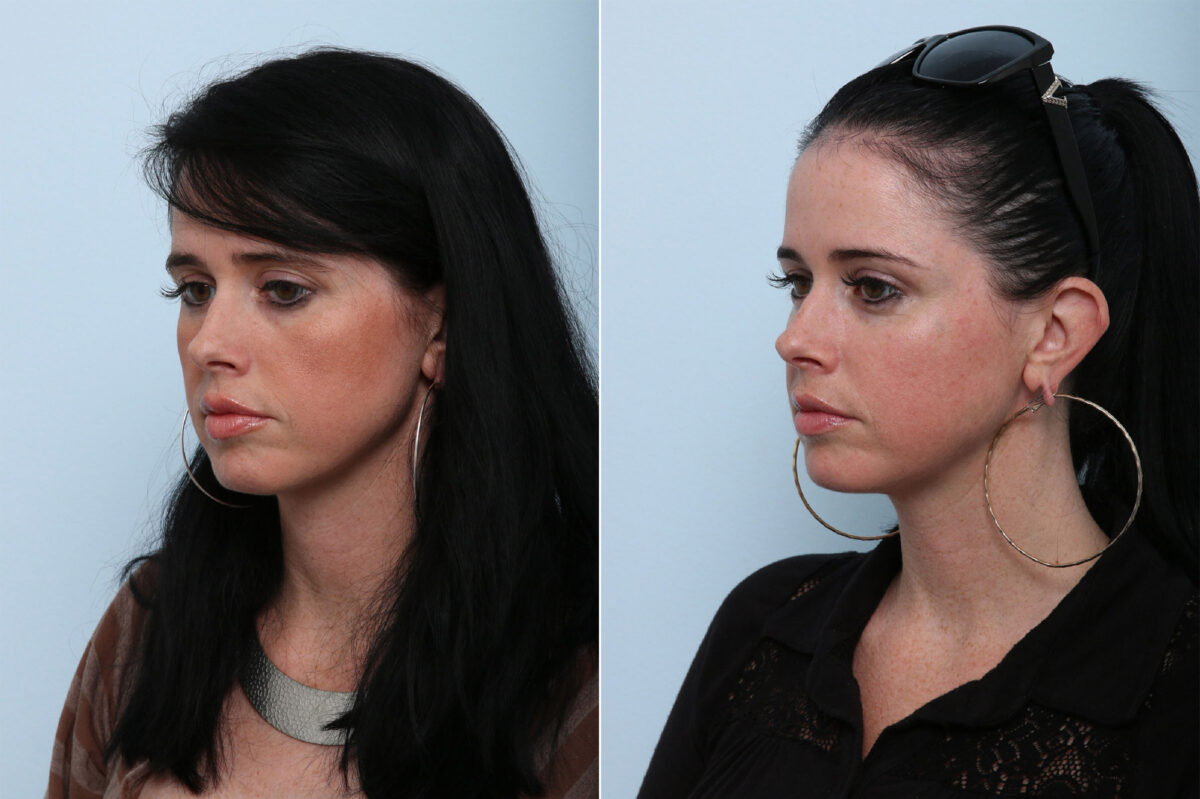 Juvederm Voluma XC before and after photos in Houston, TX, Patient 42644