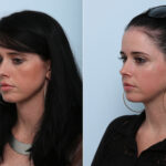 Juvederm Voluma XC before and after photos in Houston, TX, Patient 42644