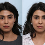 Juvederm Voluma XC before and after photos in Houston, TX, Patient 42657