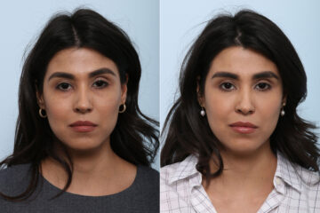 Juvederm Voluma XC before and after photos in Houston, TX, Patient 42657