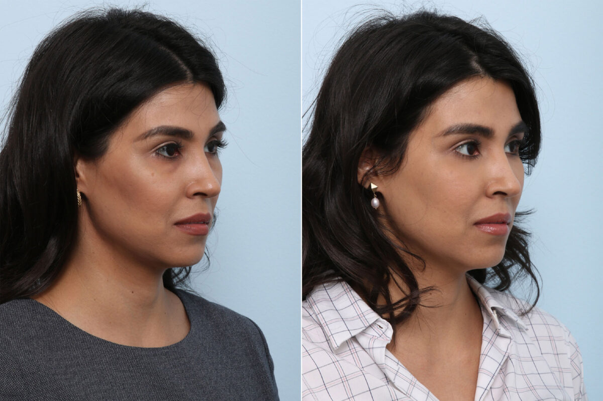 Juvederm Voluma XC before and after photos in Houston, TX, Patient 42657