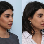 Juvederm Voluma XC before and after photos in Houston, TX, Patient 42657