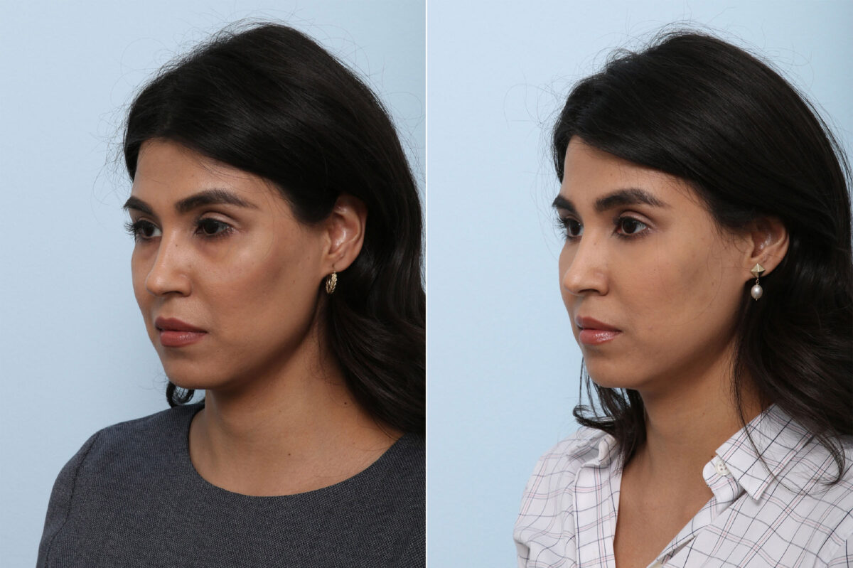 Juvederm Voluma XC before and after photos in Houston, TX, Patient 42657
