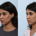 Juvederm Voluma XC before and after photos in Houston, TX, Patient 42657