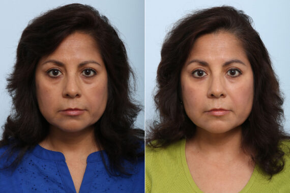 Juvederm Voluma XC before and after photos in Houston, TX, Patient 42670