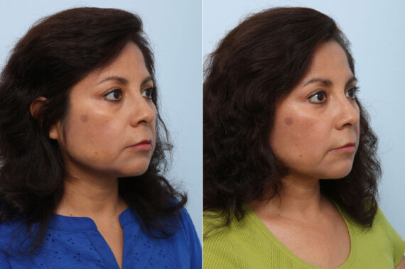 Juvederm Voluma XC before and after photos in Houston, TX, Patient 42670