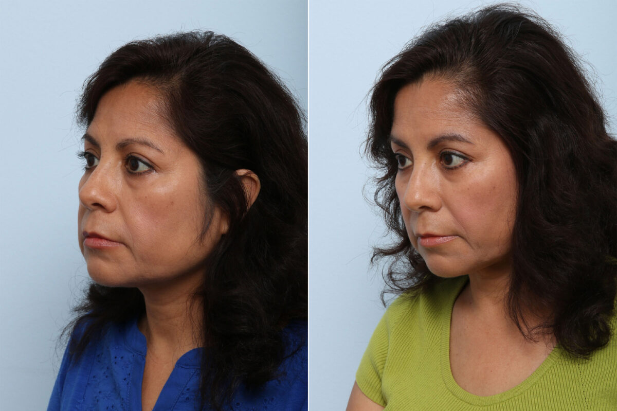 Juvederm Voluma XC before and after photos in Houston, TX, Patient 42670