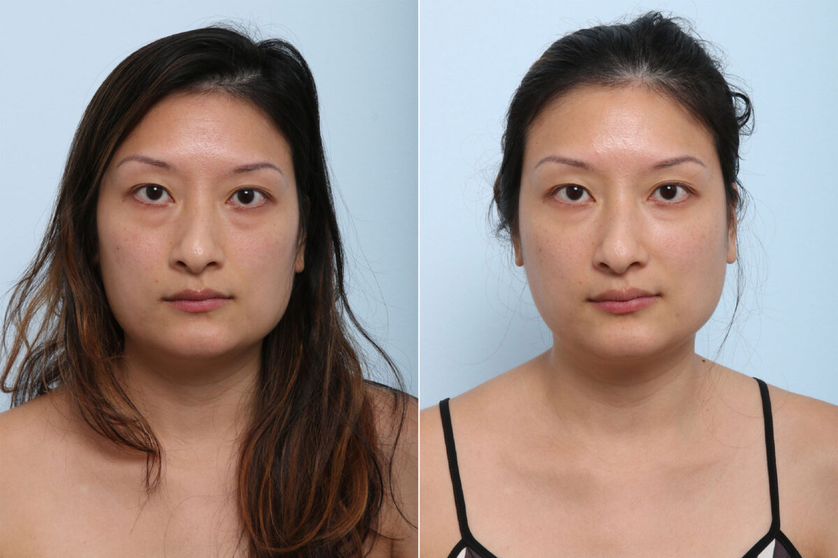 Juvederm Voluma XC before and after photos in Houston, TX, Patient 42683