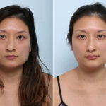 Juvederm Voluma XC before and after photos in Houston, TX, Patient 42683