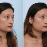 Juvederm Voluma XC before and after photos in Houston, TX, Patient 42683