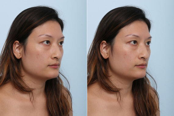 Juvederm Voluma XC before and after photos in Houston, TX, Patient 42683