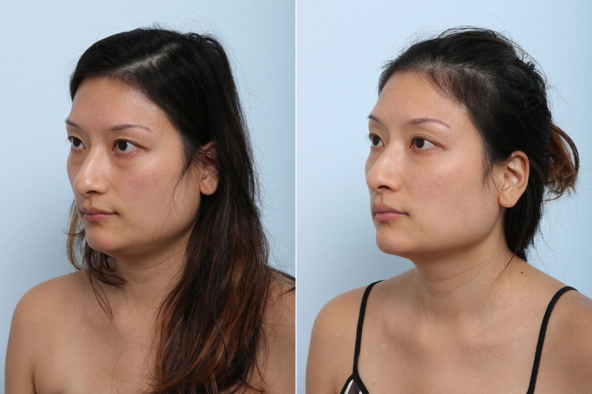 Juvederm Voluma XC before and after photos in Houston, TX, Patient 42683