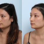 Juvederm Voluma XC before and after photos in Houston, TX, Patient 42683
