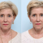Juvederm Voluma XC before and after photos in Houston, TX, Patient 42696