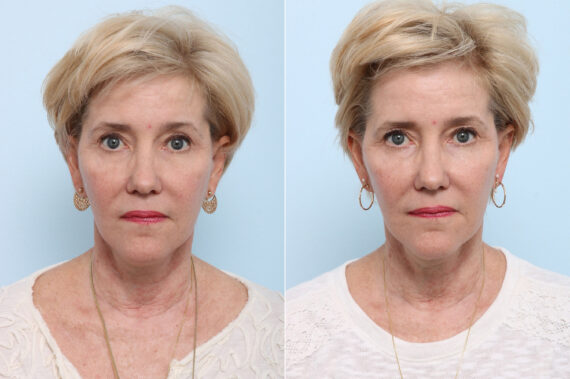 Juvederm Voluma XC before and after photos in Houston, TX