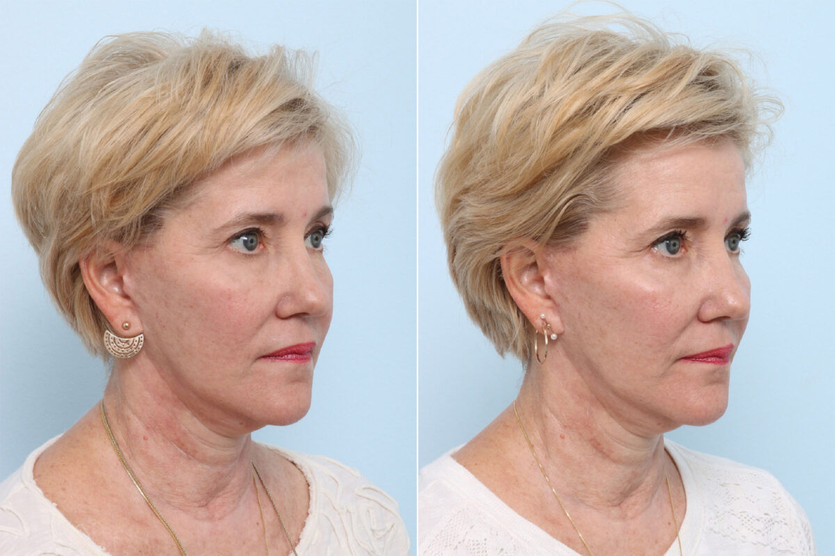 Juvederm Voluma XC before and after photos in Houston, TX, Patient 42696