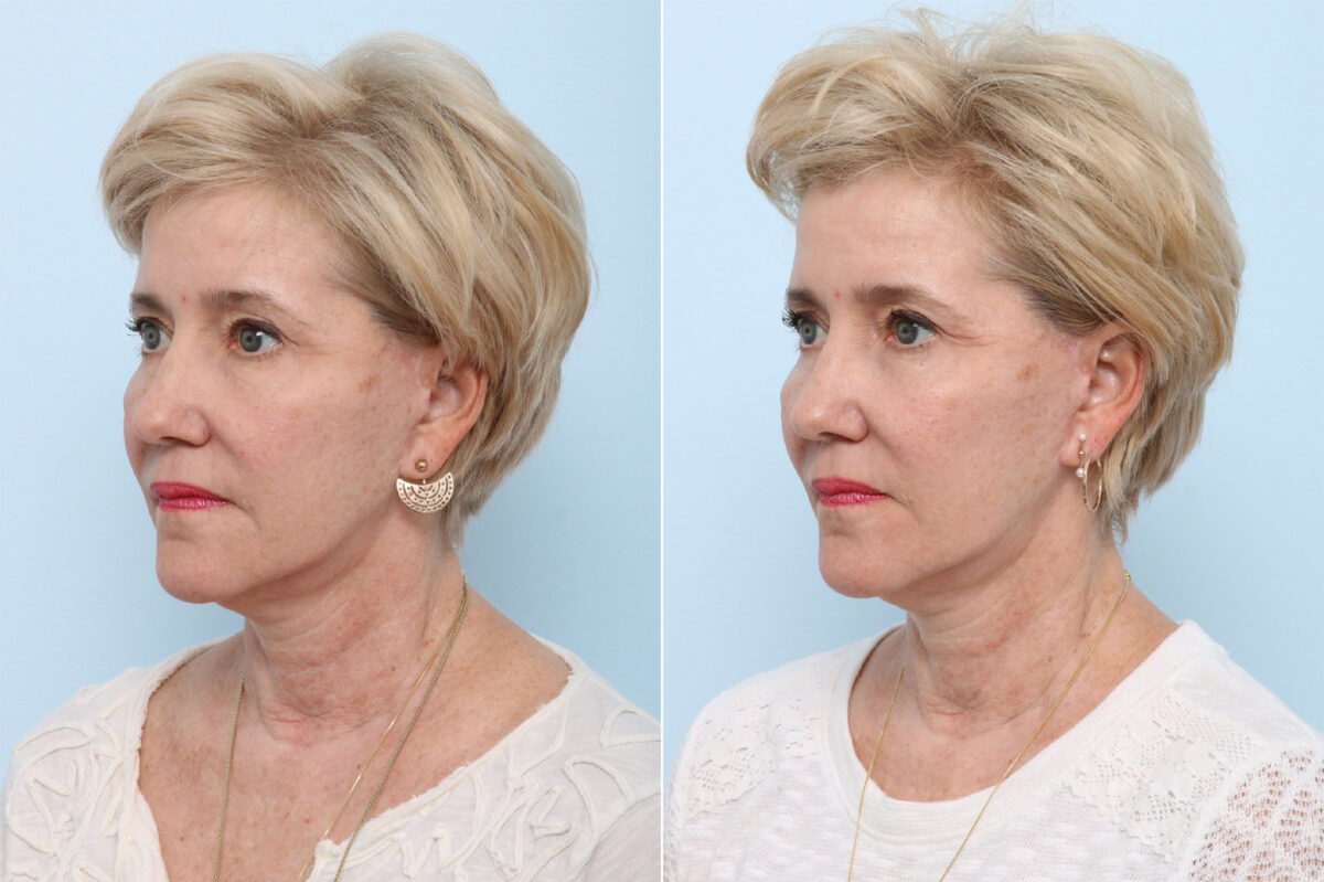 Juvederm Voluma XC before and after photos in Houston, TX, Patient 42696