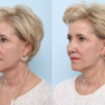 Juvederm Voluma XC before and after photos in Houston, TX, Patient 42696