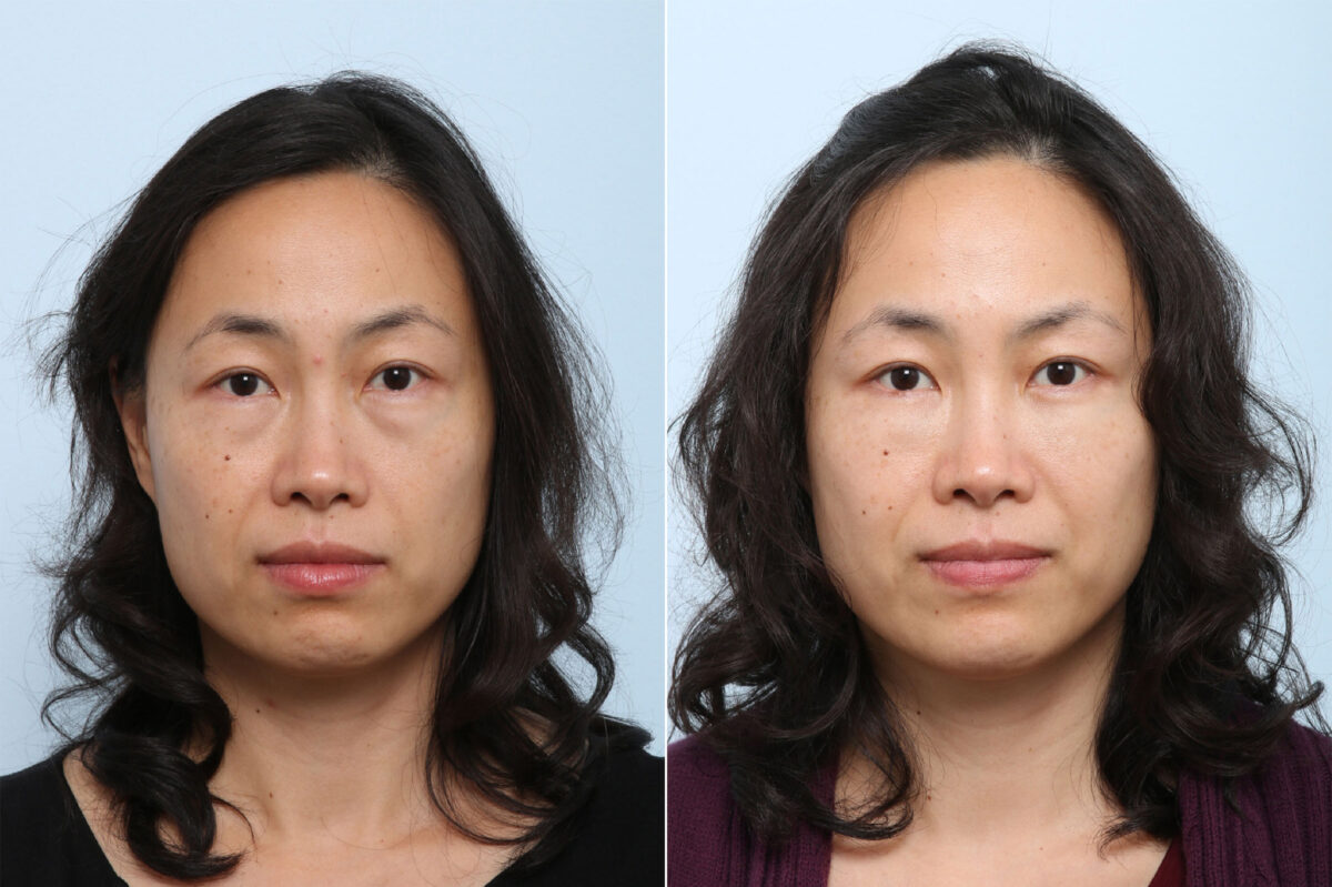 Juvederm Voluma XC before and after photos in Houston, TX, Patient 42709