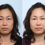 Juvederm Voluma XC before and after photos in Houston, TX, Patient 42709