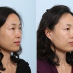 Juvederm Voluma XC before and after photos in Houston, TX, Patient 42709