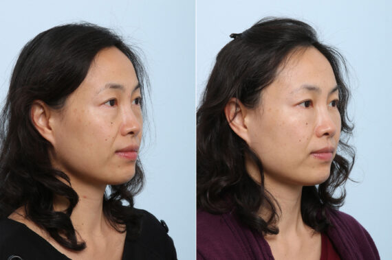 Juvederm Voluma XC before and after photos in Houston, TX, Patient 42709