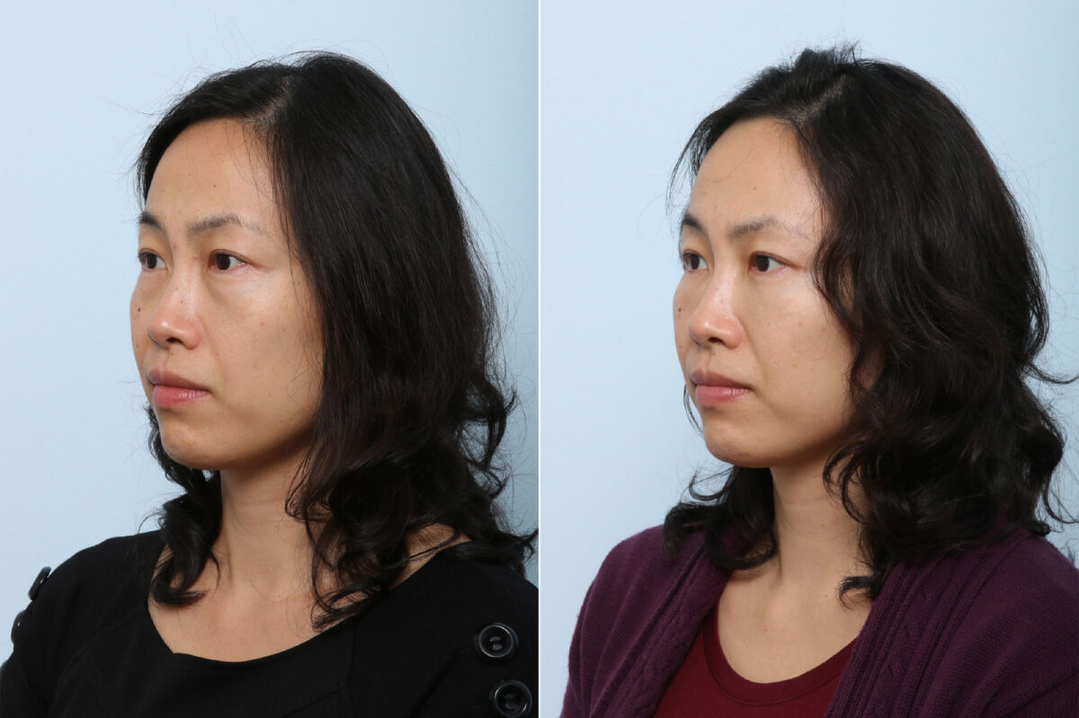 Juvederm Voluma XC before and after photos in Houston, TX, Patient 42709