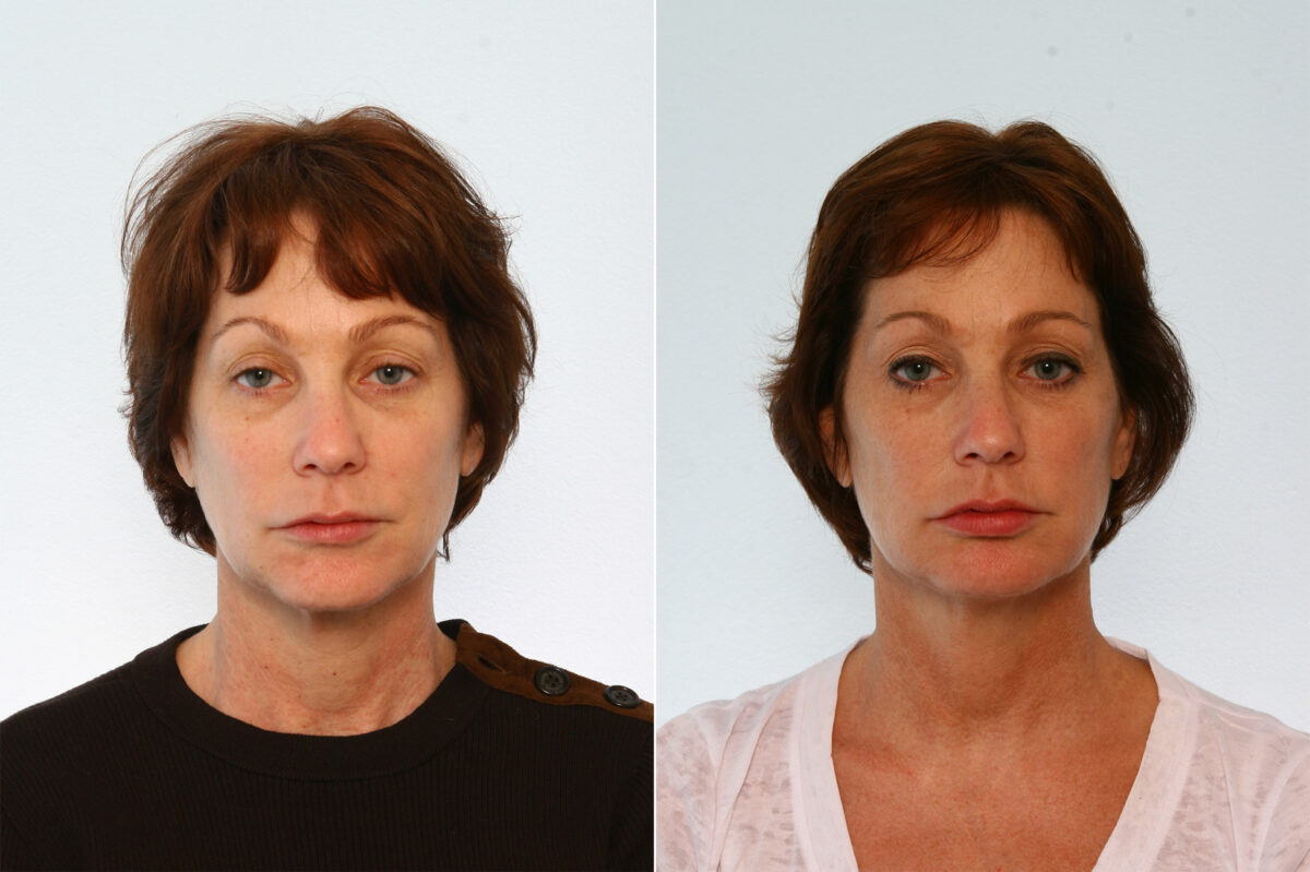 Lip Augmentation before and after photos in Houston, TX, Patient 42795
