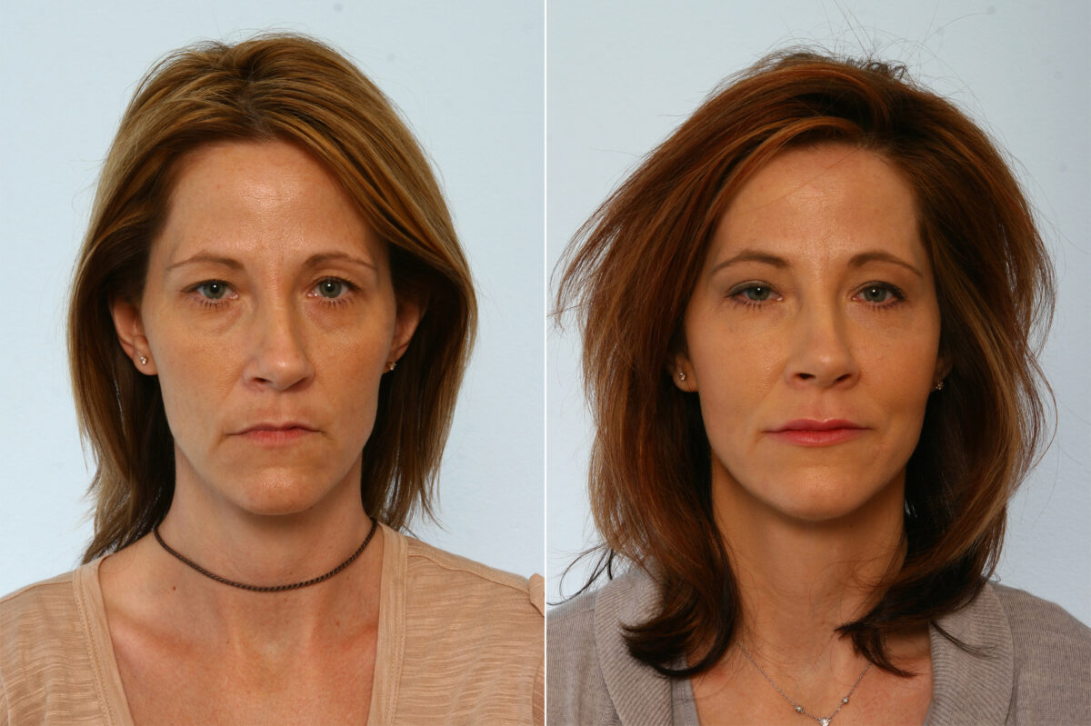 Lip Augmentation before and after photos in Houston, TX, Patient 42801