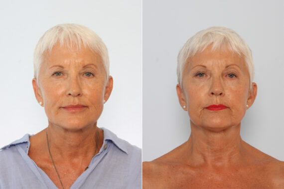 Lip Augmentation before and after photos in Houston, TX, Patient 42826