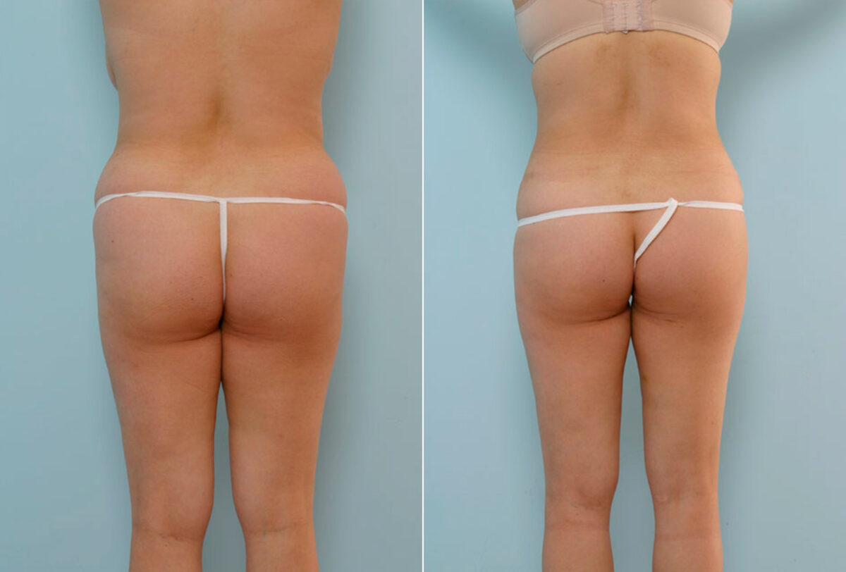 Tummy Tuck/Abdominoplasty before and after photos in Houston, TX, Patient 24252