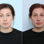 Non-Surgical Rhinoplasty before and after photos in Houston, TX, Patient 43108