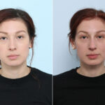 Non-Surgical Rhinoplasty before and after photos in Houston, TX, Patient 43108