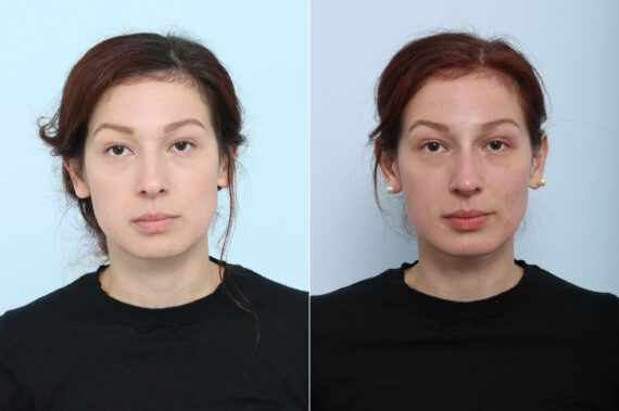 Non-Surgical Rhinoplasty before and after photos in Houston, TX, Patient 43108