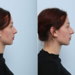 Non-Surgical Rhinoplasty before and after photos in Houston, TX, Patient 43108