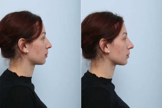 Non-Surgical Rhinoplasty before and after photos in Houston, TX, Patient 43108