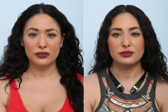 Non-Surgical Rhinoplasty before and after photos in Houston, TX, Patient 43115